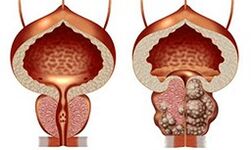 Healthy and unhealthy prostate